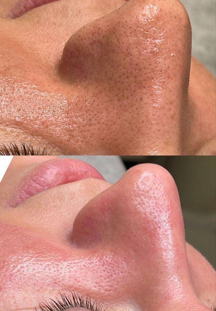 Antes e depois da limpeza de pele profissional em Campinas — remoção de cravos no nariz